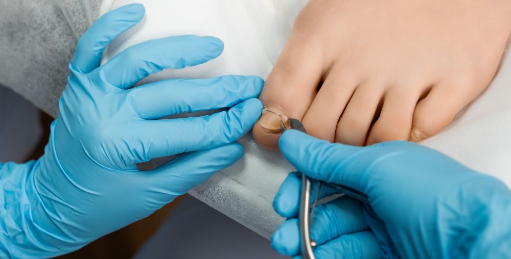 unas-encarnadas-operacion cirugia de uñas encarnadas en Houston, Texas