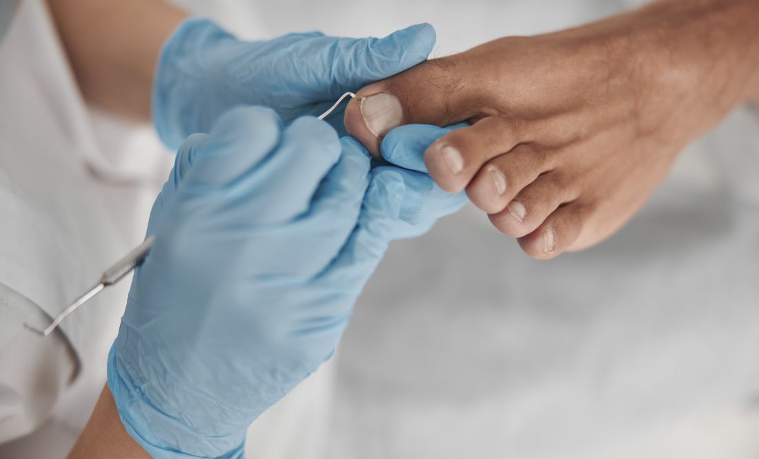 unas-enterradas-encarnadas-houston uñas encarnadas cirugia en houston