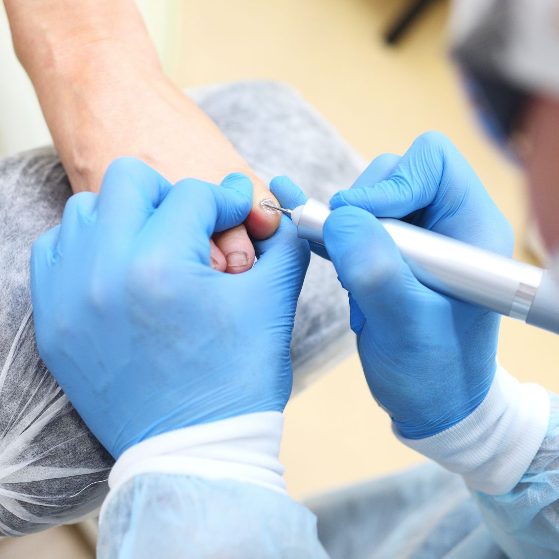 unas-enterradas-houston uñas encarnadas tratamiento en houston